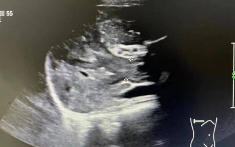 浙江24岁妈妈确诊癌症晚期：我孩子才3岁！医生痛惜：早有症状
