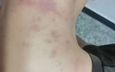 脖子上拍了个隐翅虫会有怎样的下场？