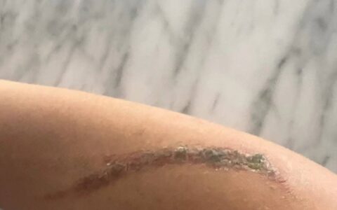 女子拍打毒隐翅虫后皮炎10天未愈，专家：不要拍打，它们不咬人